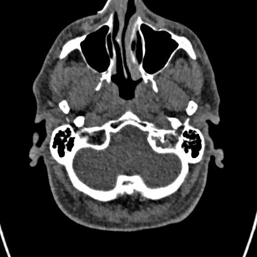 File:Cerebral arteriovenous malformation (Radiopaedia 78188-90746 Axial non-contrast 21).jpg