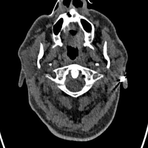 Cerebral arteriovenous malformation (Radiopaedia 78188-90746 Axial non-contrast 3).jpg