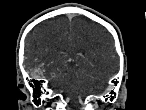 Cerebral arteriovenous malformation (Radiopaedia 78188-90746 Coronal C+ delayed 79).jpg