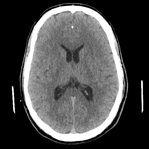 Cerebral arteriovenous malformation (Spetzler-Martin grade 2) (Radiopaedia 41262-44076 Axial non-contrast 31).png