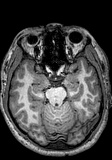File:Cerebral arteriovenous malformation at posterior body of corpus callosum (Radiopaedia 74111-84925 Axial T1 200).jpg