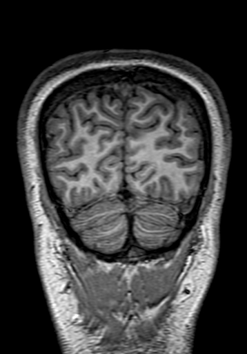 Cerebral arteriovenous malformation at posterior body of corpus callosum (Radiopaedia 74111-84925 Coronal T1 309).jpg