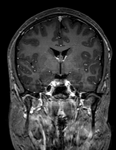 Cerebral arteriovenous malformation at posterior body of corpus callosum (Radiopaedia 74111-84925 K 162).jpg