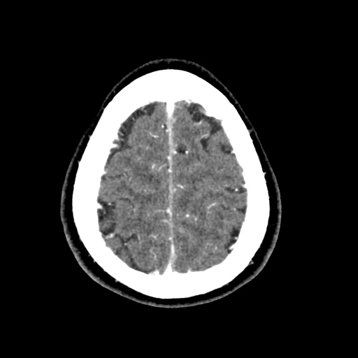 Cerebral arteriovenous malformation with lobar hemorrhage (Radiopaedia 35598-57216 A 53).jpg