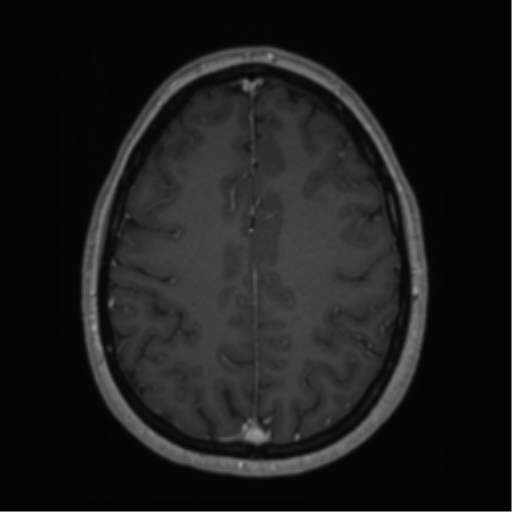 Cerebral cavernoma and development venous anomaly (Radiopaedia 37603-39482 Axial T1 C+ 54).png