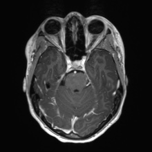 Cerebral cavernous venous malformation (Radiopaedia 70008-80021 Axial T1 C+ 22).jpg
