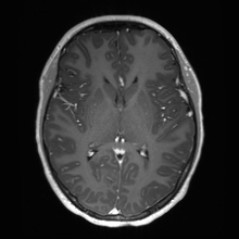 File:Cerebral cavernous venous malformation (Radiopaedia 70008-80021 Axial T1 C+ 37).jpg
