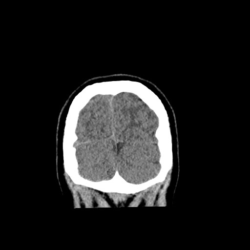 Cerebral cavernous venous malformation (Radiopaedia 70008-80022 non-contrast 64).jpg