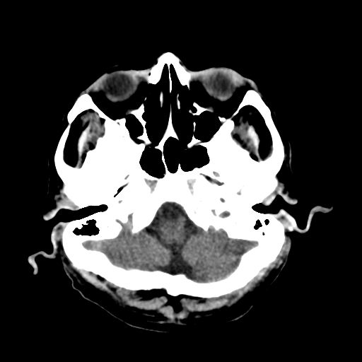 File:Cerebral contusions, subarachnoid hemorrhage and subdural hygromas (Radiopaedia 55399-61827 Axial non-contrast 8).png