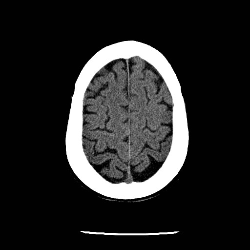 Cerebral edema (evolution in time) (Radiopaedia 19418-19441 non-contrast 77).jpg