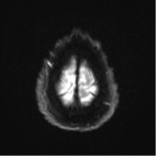 File:Cerebral embolic infarcts (embolic shower) (Radiopaedia 57395-64342 Axial DWI 34).png