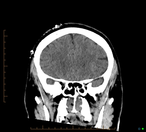 Cerebral fat embolism (Radiopaedia 85521-101224 Coronal non-contrast 21).jpg