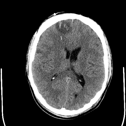 File:Cerebral hemorrhagic contusions- temporal evolution (Radiopaedia 40224-42754 Axial non-contrast 16).png