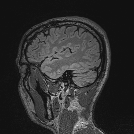 File:Cerebral hemorrhagic contusions- temporal evolution (Radiopaedia 40224-42757 Sagittal T1 19).png