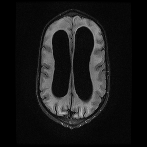 File:Cerebral manifestations of mucopolysaccharidosis type I (Radiopaedia 59171-66487 Axial FLAIR 15).jpg