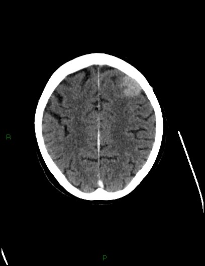 Cerebral metastases - ependymal and parenchymal (Radiopaedia 79877-93131 Axial C+ delayed 62).jpg
