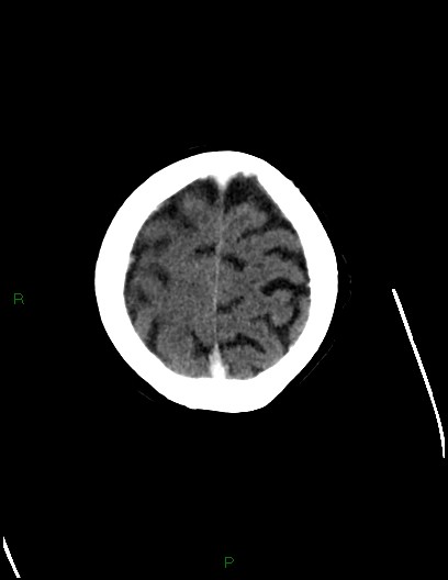 Cerebral metastases - ependymal and parenchymal (Radiopaedia 79877-93131 Axial C+ delayed 73).jpg