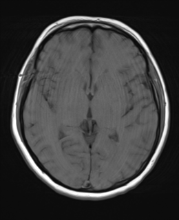 File:Cerebral metastases mimicking abscesses (Radiopaedia 45841-50131 Axial T1 15).png