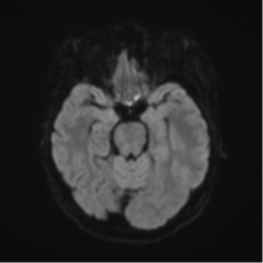 File:Cerebral metastasis (Radiopaedia 46744-51248 Axial DWI 38).png