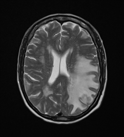 File:Cerebral metastasis (Radiopaedia 46744-51248 Axial T2 17).png