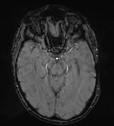 Cerebral metastasis - melanoma (Radiopaedia 54718-60954 Axial SWI 22).png