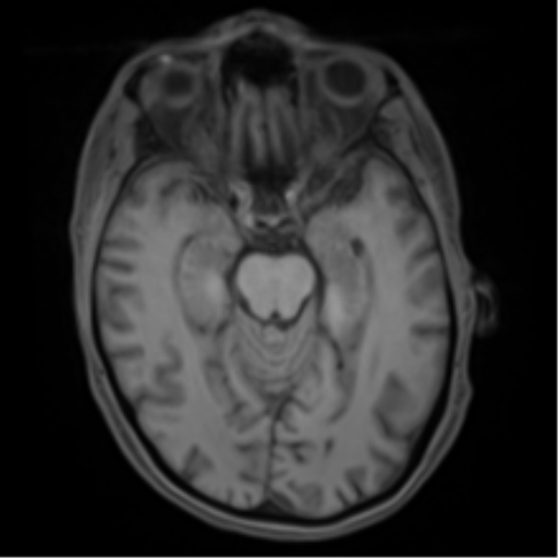 Cerebral metastasis - melanoma (Radiopaedia 54718-60954 Axial T1 21).png