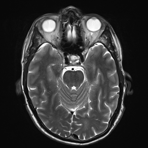 File:Cerebral metastasis - melanoma (Radiopaedia 54718-60954 Axial T2 11).png