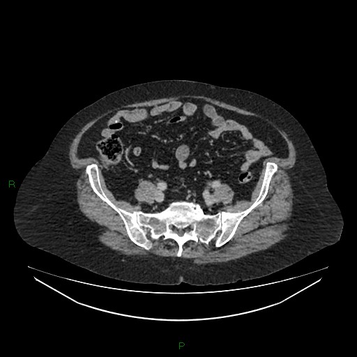 File:Cerebral metastasis from renal cell carcinoma (Radiopaedia 82306-96378 A 136).jpg