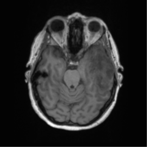Cerebral metastasis mimicking glioblastoma (Radiopaedia 69155-78937 Axial T1 19).png