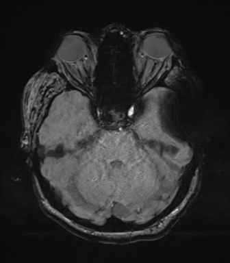 Cerebral metastasis to basal ganglia (Radiopaedia 81568-95413 Axial SWI magnitude 24).png