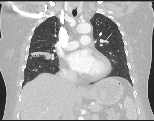File:Cerebral metastasis to basal ganglia (Radiopaedia 81568-95414 Coronal lung window 42).png