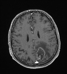 Cerebral toxoplasmosis (Radiopaedia 43956-47461 Axial T1 C+ 52).jpg