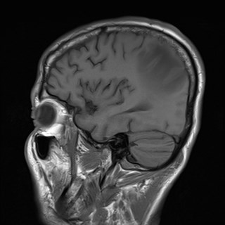 File:Cerebral toxoplasmosis (Radiopaedia 43956-47461 Sagittal T1 16).jpg