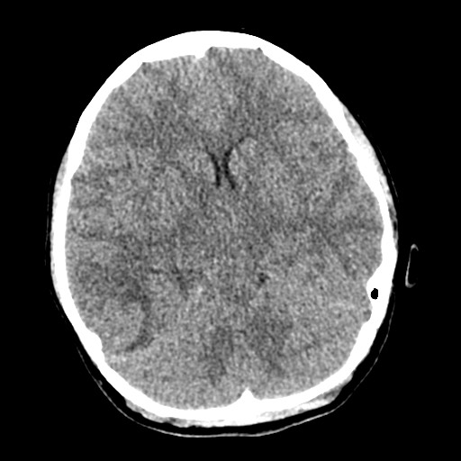 Cerebral tuberculosis with dural sinus invasion (Radiopaedia 60353-68018 Axial non-contrast 23).jpg