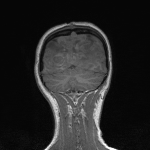 Cerebral tuberculosis with dural sinus invasion (Radiopaedia 60353-68090 Coronal T1 150).jpg