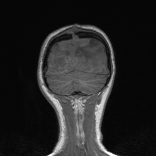 Cerebral tuberculosis with dural sinus invasion (Radiopaedia 60353-68090 Coronal T1 155).jpg