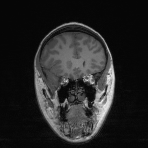 Cerebral tuberculosis with dural sinus invasion (Radiopaedia 60353-68090 Coronal T1 59).jpg