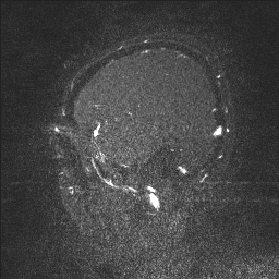 Cerebral tuberculosis with dural sinus invasion (Radiopaedia 60353-68090 Sagittal MRV 20).jpg