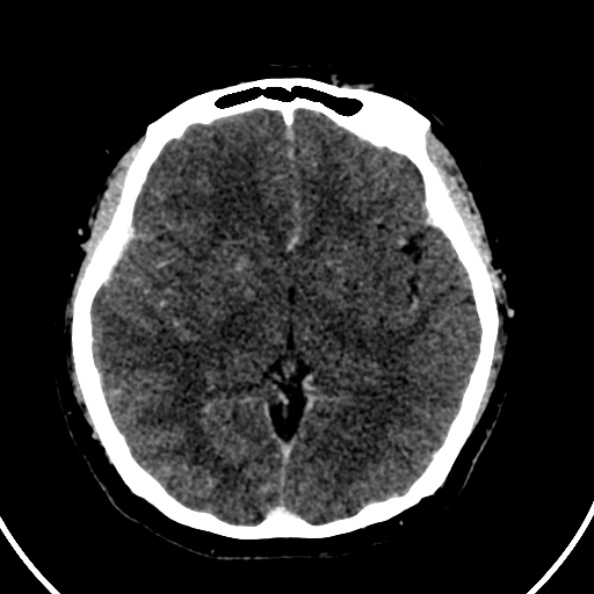 File:Cerebral venous hemorrhagic infarct from venous sinus thrombosis (Radiopaedia 55433-61883 Axial C+ delayed 80).jpg