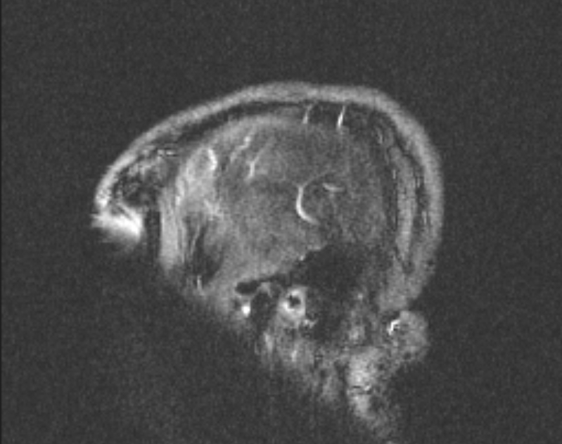 Cerebral venous infarction (Radiopaedia 65166-74176 Sagittal TOF 68).jpg