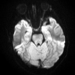 File:Cerebral venous infarction - hemorrhagic (Radiopaedia 81625-95505 Axial DWI 7).jpg