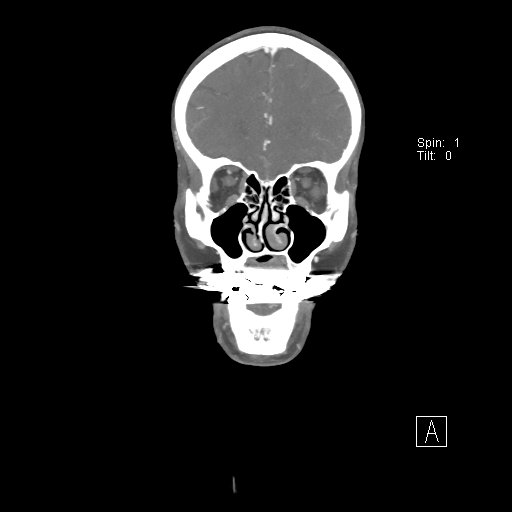 Cerebral venous infarction with hemorrhage (Radiopaedia 65343-74396 B 70).jpg
