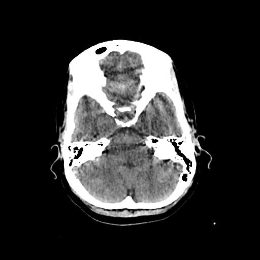 Cerebral venous throbmosis - hemorrhagic venous infarction (Radiopaedia 87318-103613 Axial non-contrast 42).jpg