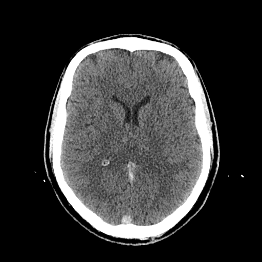File:Cerebral venous thrombosis (CVT) (Radiopaedia 77524-89685 Axial non-contrast 27).jpg
