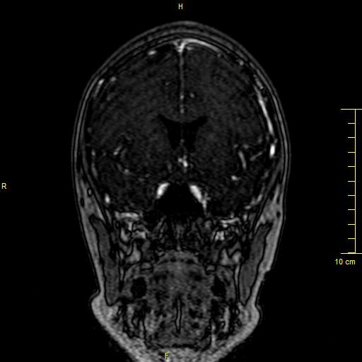 Cerebral venous thrombosis (Radiopaedia 23288-23351 MRV 43).JPG