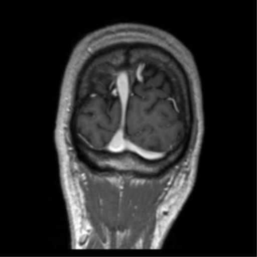 Cerebral venous thrombosis (Radiopaedia 38392-40469 Coronal T1 C+ 8).png