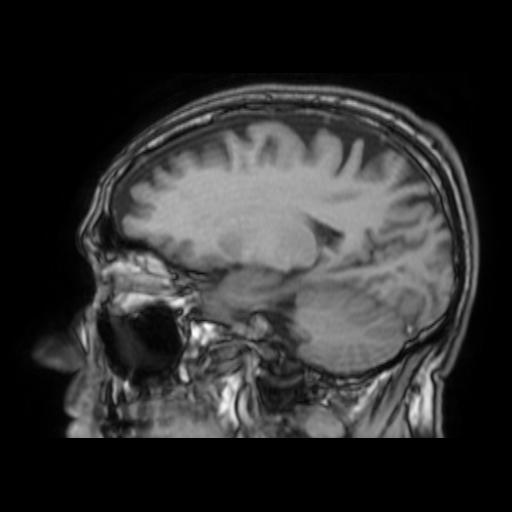 File:Cerebral venous thrombosis with secondary intracranial hypertension (Radiopaedia 89842-106957 Sagittal T1 12).jpg