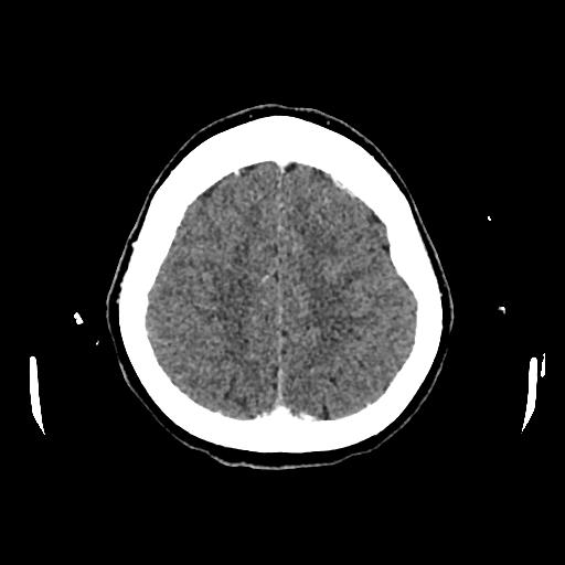 File:Cerebral venous thrombosis with venous hemorrhagic infarct (Radiopaedia 90354-107660 Axial with contrast 131).jpg