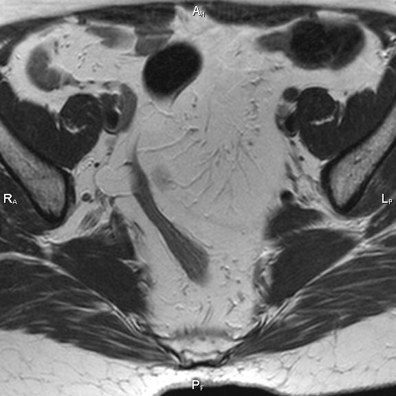 File:Cervical adenocarcinoma (Radiopaedia 65011-73985 Axial T2 28).jpg