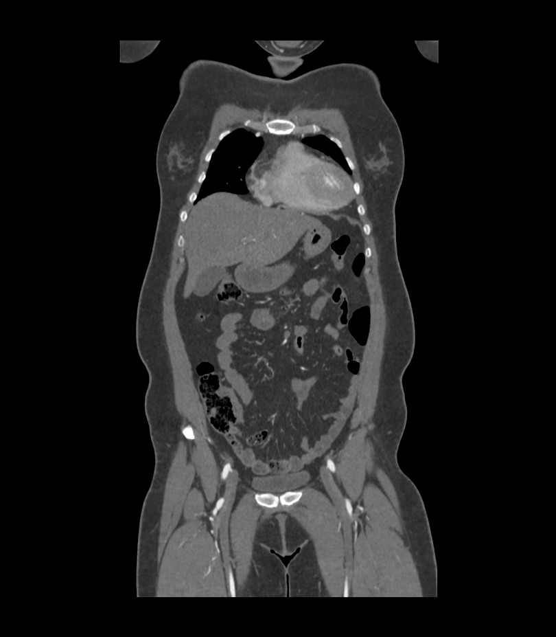 Cervical aortic arch with coarctation and aneurysms (Radiopaedia 44035-47552 C 36).jpg